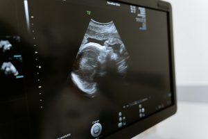Injectarea intracitoplasmatica a spermei (ICSI), modalitate alternativa pentru reproducerea umana asistata si o sarcina sanatoasa
