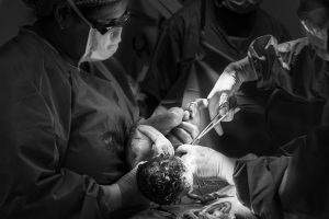 Prolapsul rectal si nasterea vaginala. Riscuri si tratament