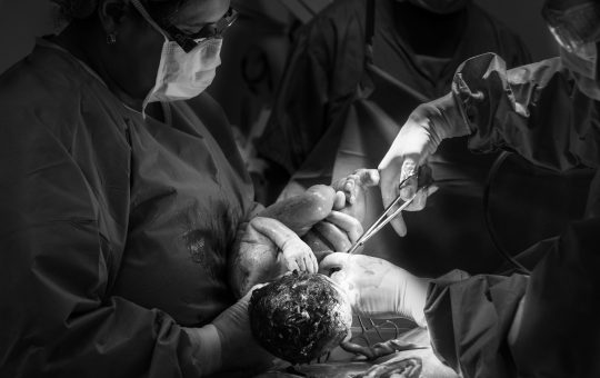 Prolapsul rectal si nasterea vaginala. Riscuri si tratament
