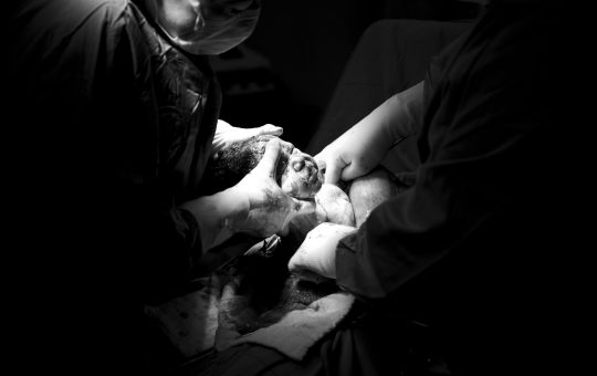 Sindromul Hamman sau pneumomediastin spontan in timpul travaliului, nasterii