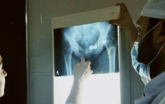 Boala inflamatorie pelvina, infectia tractului genital superior feminin care poate afecta fertilitatea